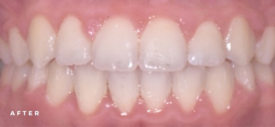 photo of teeth after braces