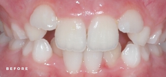 photo of teeth before braces