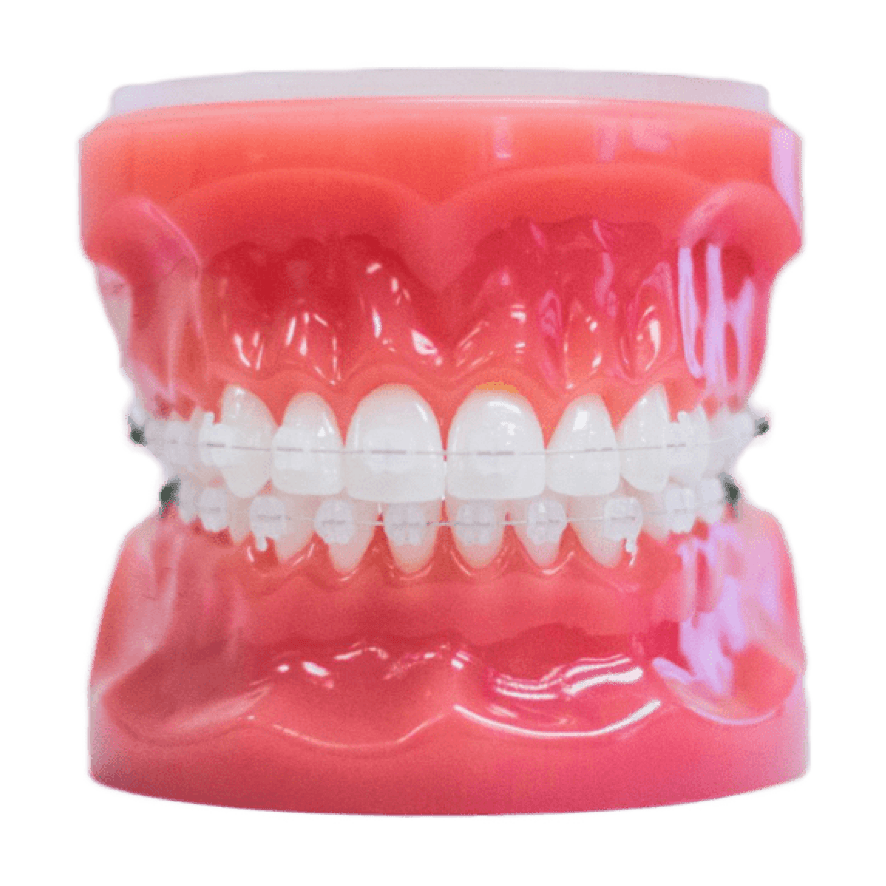 clear braces on plastic model