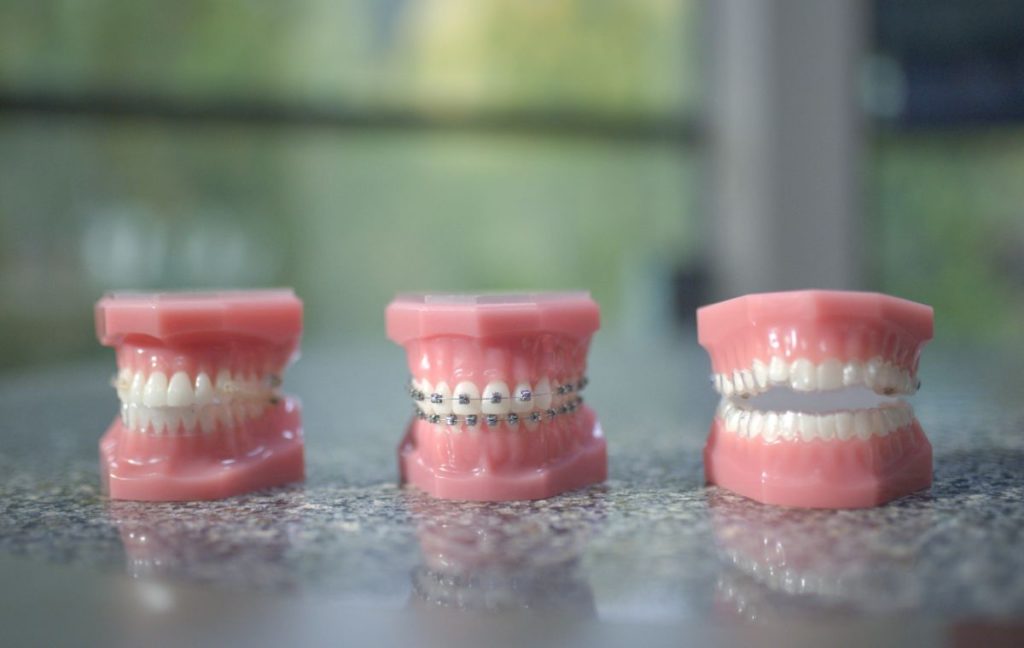 Misconceptions About Orthodontics