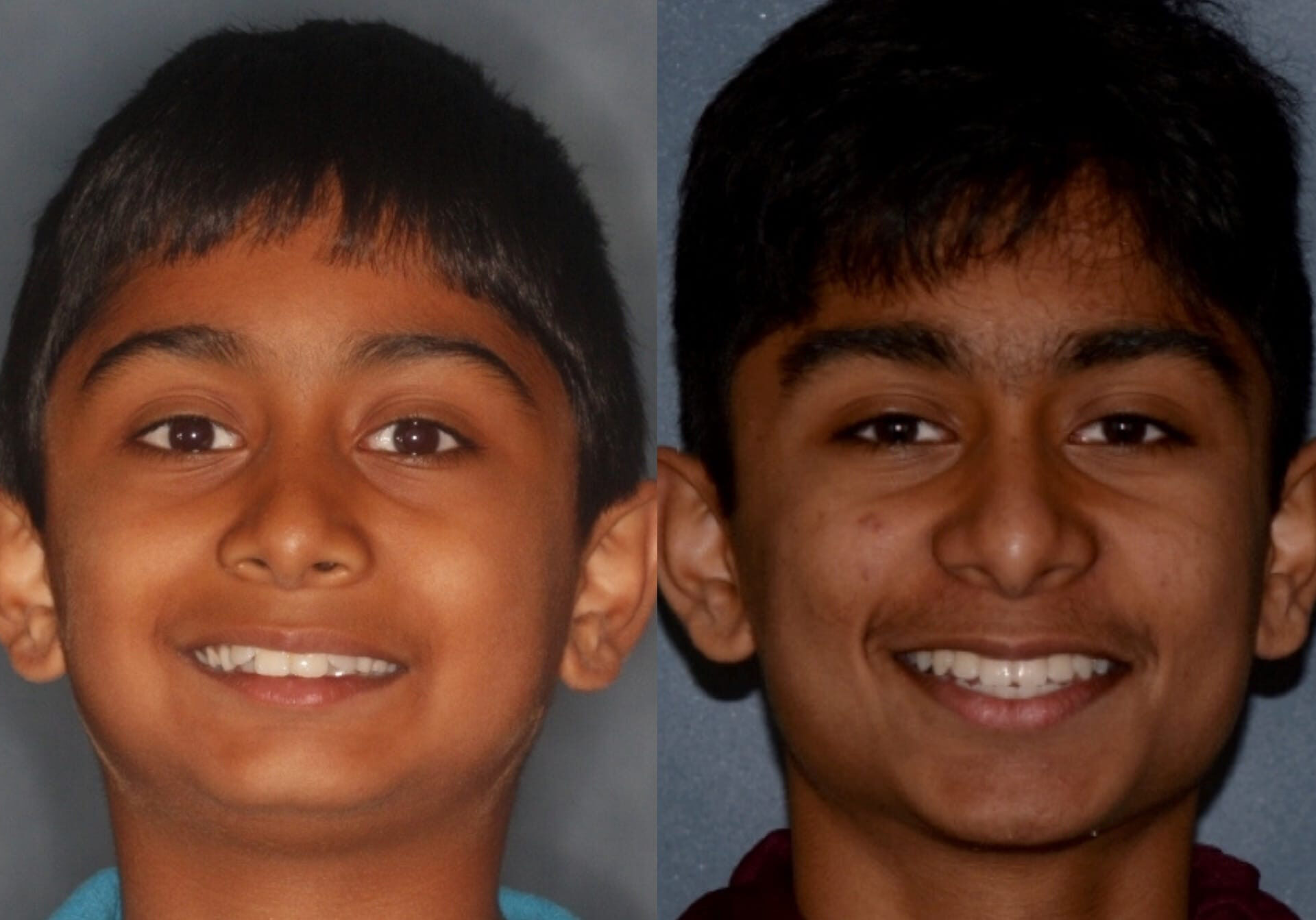 Before and After Orthodontic Pictures