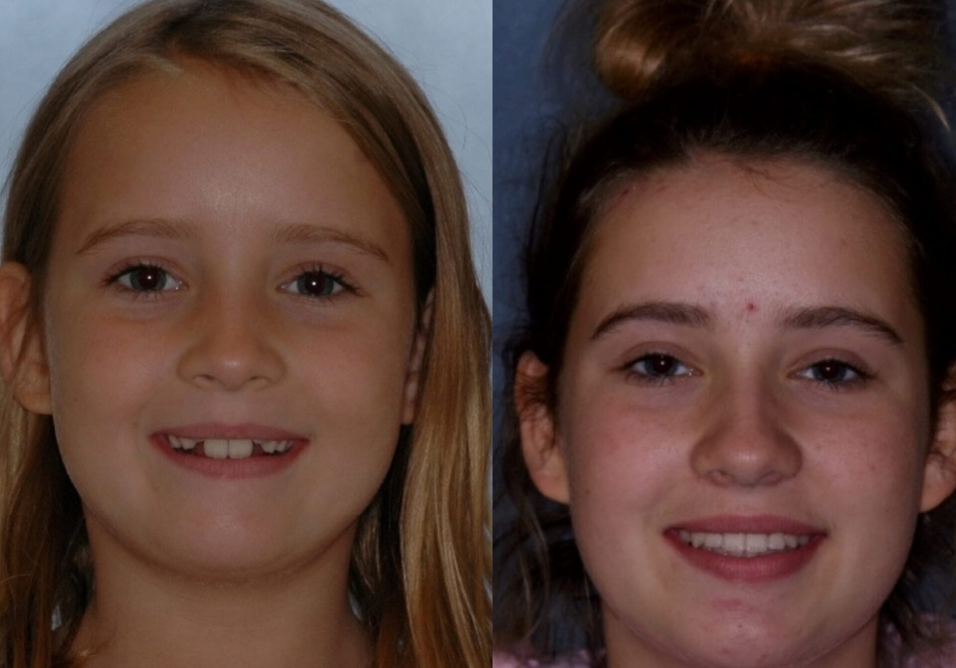 Before and After Orthodontic Pictures